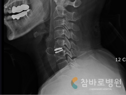 목뼈(경추)부분 인공디스크 삽입 수술한 상태