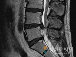 허리의 디스크 부분이 나온 상태