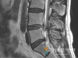 내시경하 수핵 절제술 수술 살례