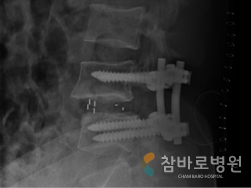 탈출한 디스크를 척추 유합술로 교정 수술한 사례