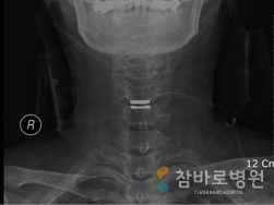 목뼈(경추)부분 인공디스크 삽입 수술한 상태