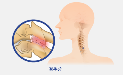 경추증