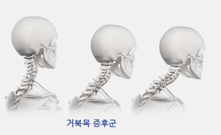 거북목 증후군