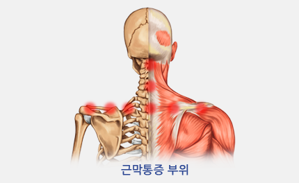 근막통증 부위