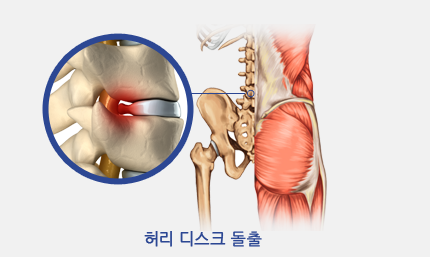 허리 디스크 돌출