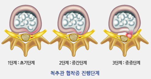 척추관 협착증 진행단계 / 1단계:초기단계 2단계:중간단계 3단계:중중단계