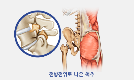 전방전위로 나온 척추