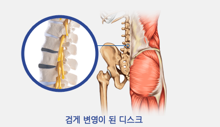 검게 변영이 된 디스크