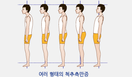 여러 형태의 척추측만증