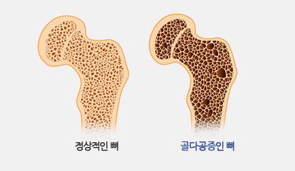 정상적인 뼈 / 골다공증인 뼈