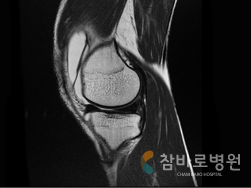 추벽증후군 사진