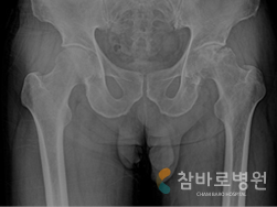 좌측 대퇴골두 무혈성 괴사