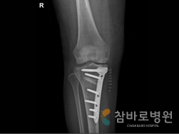 교정핀으로 교정 사진