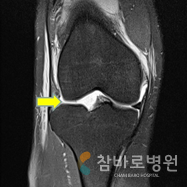 월상 연골 이식술 사진