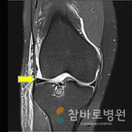 월상 연골 이식술 사진