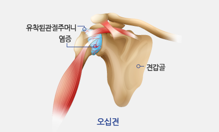 오십견 그림 - 유착된 관절주머니, 염증, 견갑골