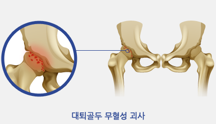 대퇴골두 무혈성 괴사