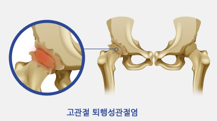 고관절 퇴행성관절염