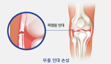 무릎 인대 손상