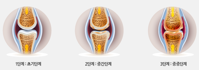 1단계:초기단계 / 2단계:중간단계 / 3단계:중중단계