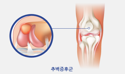 추벽증후근