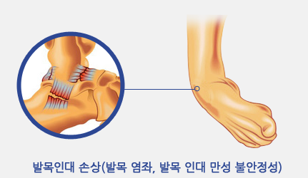 발목인대 손상(발목 염좌, 발목 인대 만성 불안정성)