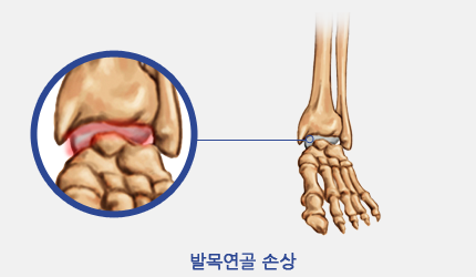 발목연골 손상