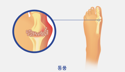 통증