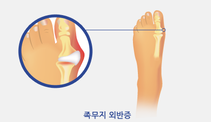 족무지 외반증