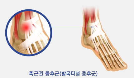 족근관 증후군(발목터널 증후군)