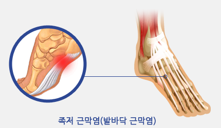 족저 근막염(발바닥 근막염)