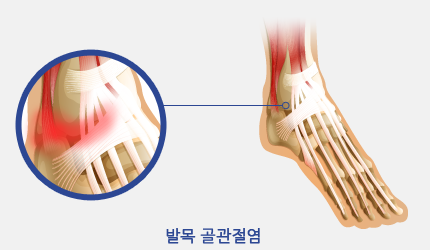 발목 골관절염