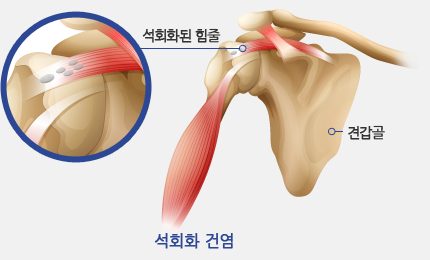 석회화된 힘줄/석회화 건염/견갑골