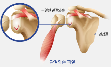 파열된 관절와순 - 관절와순 파열 - 견갑골