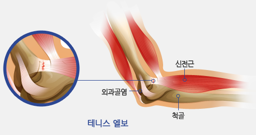 테니스 엘보 그림 / 신전근 외과골염 - 척골