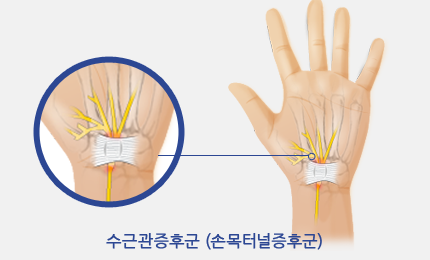 수근관증후군(손목터널증후군)