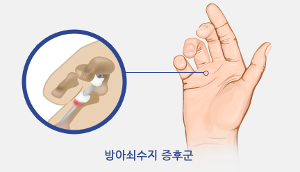 방아쇠수지 증후군